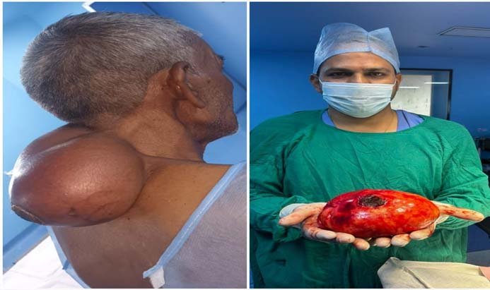 विगत 10 वर्षों से चर्बी की गठन से परेशान मरीज का धार के भोज चिकित्सालय में किया सफल ऑपरेशन