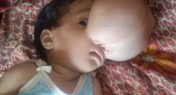 CG : चेहरे से सिस्ट काटकर डॉक्टरों ने बचाई बच्ची की जान