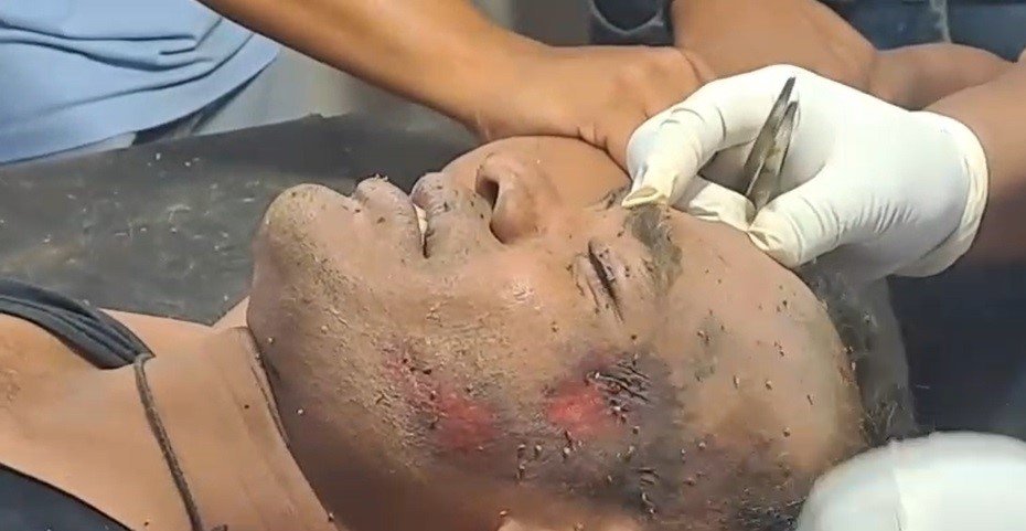 CG : ये रोड एक्सीडेंट नहीं, युवक के चेहरे पर मधुमक्खियों के डंक है…