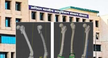 भोपाल एम्स ने हासिल की एक और बड़ी उपलब्धि, 3 डी प्रिंटिंग तकनीक से होगा हड्डी रोग का निशुल्क इलाज