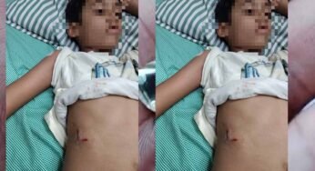 पेबल बे फेस 1, बागमुगलिया कटारा हिल्स में आवारा कुत्ते ने बच्चे को काटा