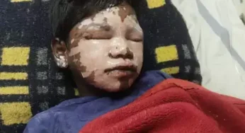 CG : आदिवासी बालक आश्रम में छात्र के ऊपर गिरा खौलता हुआ तेल…