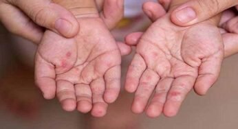 MP में खसरे की दस्तक: 4 जिलों में मिले 12 नए मरीज, स्वास्थ्य विभाग अलर्ट पर