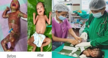 अत्यंत दुर्लभ बीमारी से जूझ रहे नवजात को बीजापुर जिला अस्पताल की SNCU में मिला नया जीवन