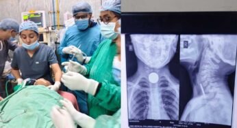 6 वर्षीय मासूम की आहार नली से सफलतापूर्वक निकाला गया सिक्का, बची जान